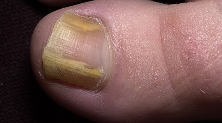 nail damage with fungal infection