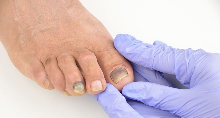 toenail examination for fungus