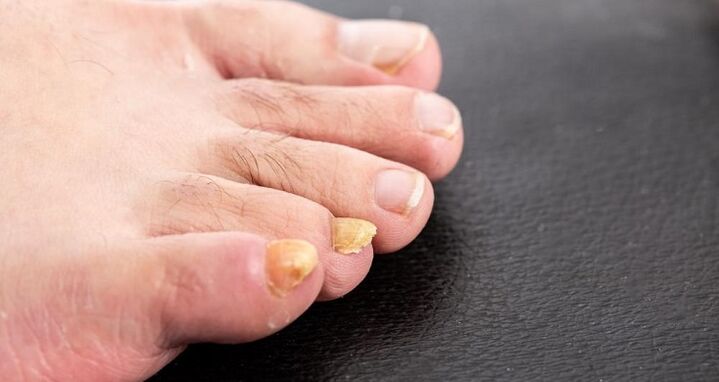 yellowing of the nails with nribka in the feet