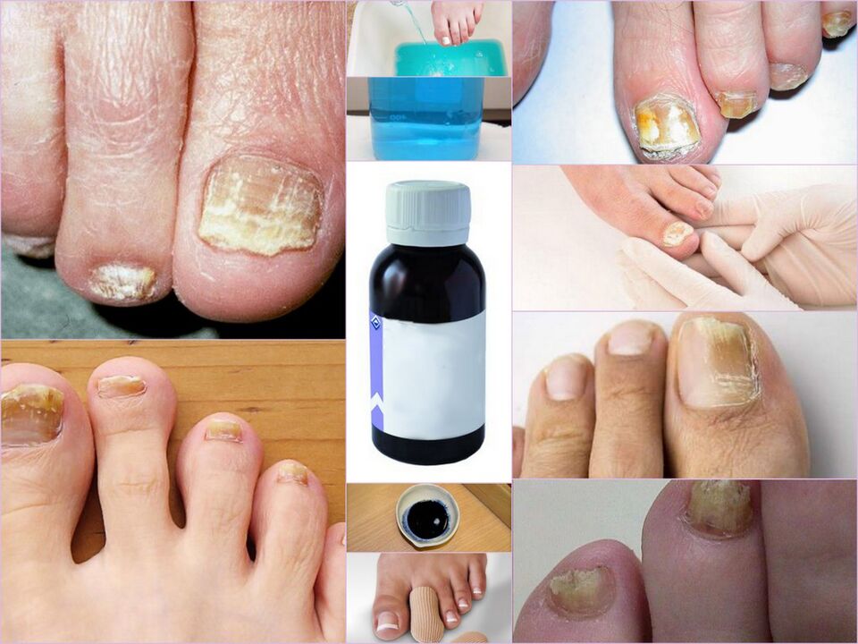 toenail fungus medications