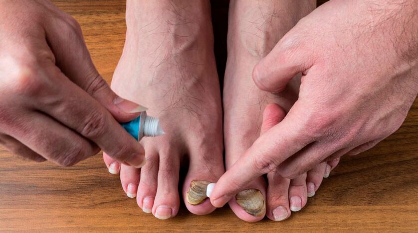 Apply an antifungal cream to the toenails to treat onychomycosis