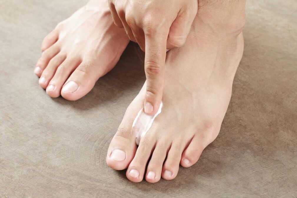 Application of a special ointment to treat the interdigital form of foot fungus