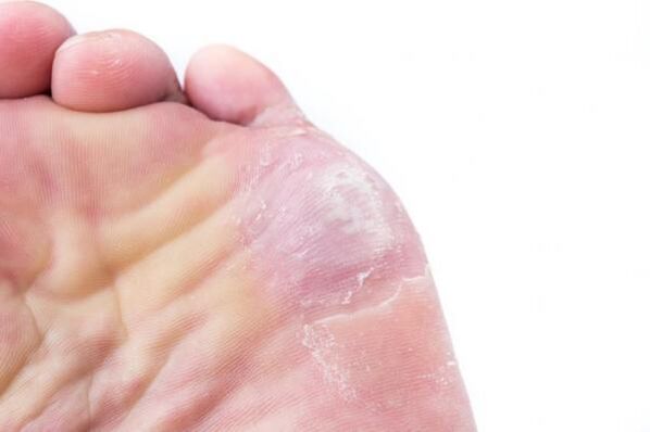 Manifestations of rubrophytosis on the skin of the foot