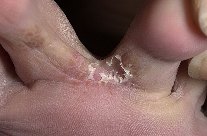 Cracked skin between the toes is a symptom of an intertriginous fungus. 