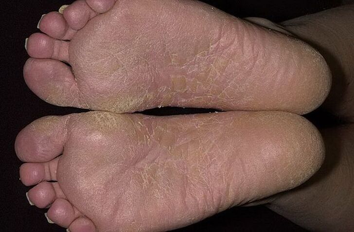 Dry, scaly skin on the feet is a sign of scaly ringworm