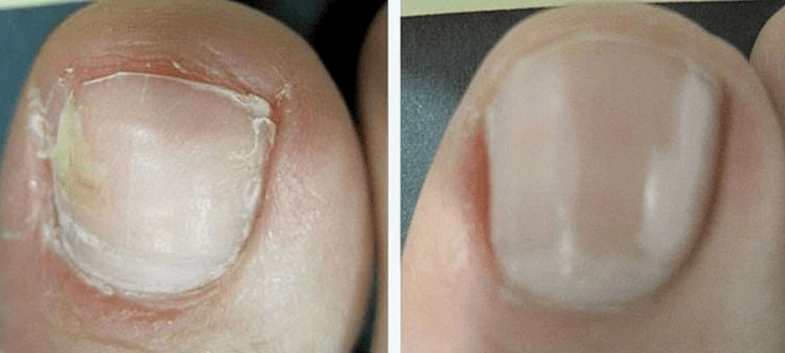 Nail before and after fungus treatment