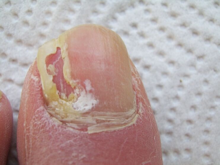 With onychomycosis, there is deformation of the nail plate