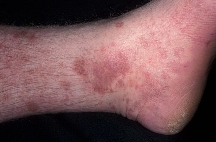 leg mycotic eczema