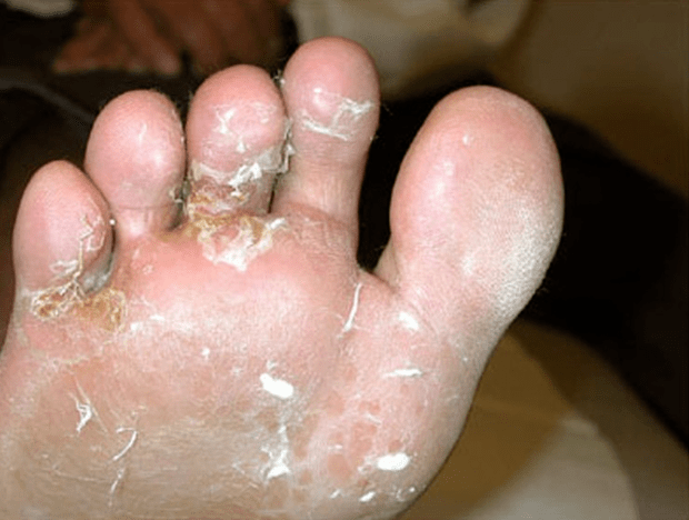 the development of fungi in the toes