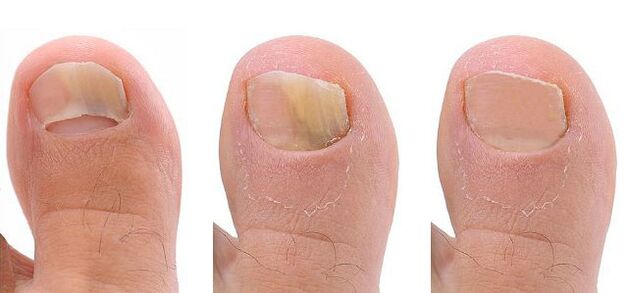 nail fungus stages