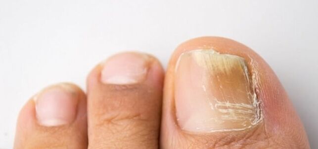 fungal nail plate infection