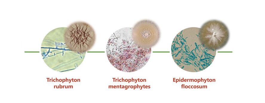 The main agents causing fungus on the skin on the legs