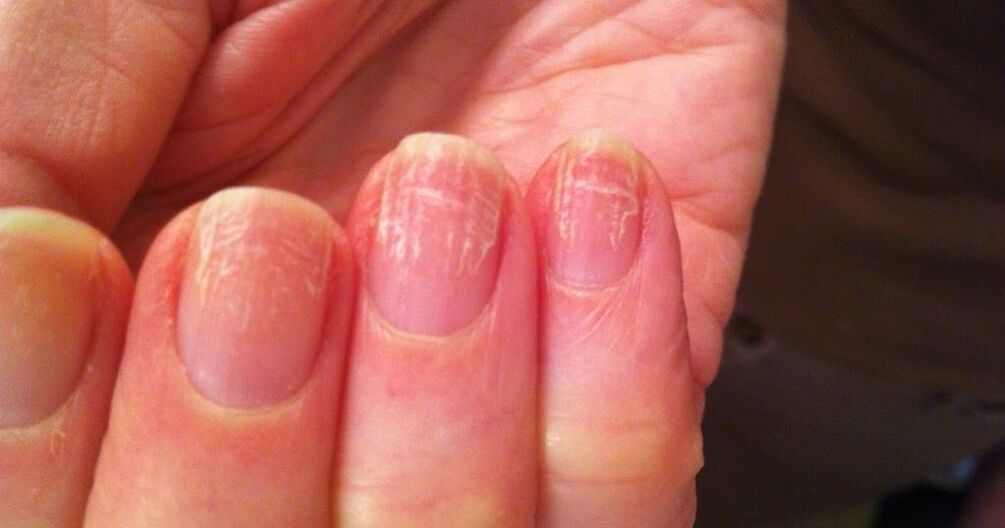 how is nail fungus