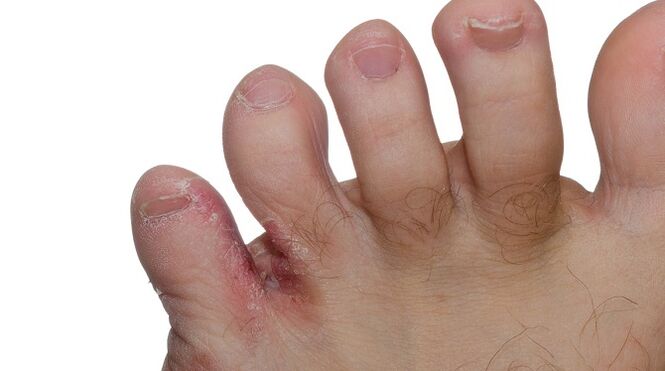 Signs of fungus between toes - cracking and peeling skin