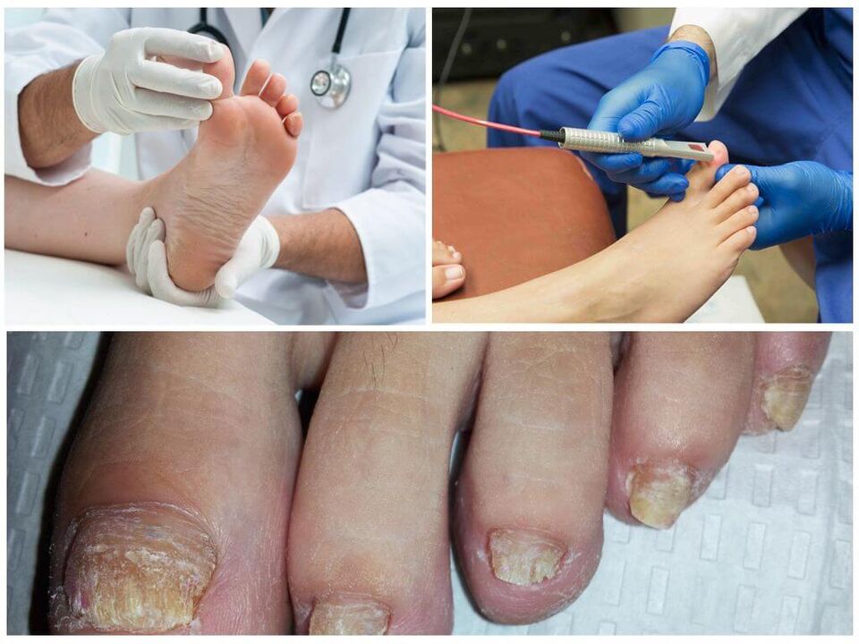 A doctor diagnoses and treats nails affected by a fungal infection. 