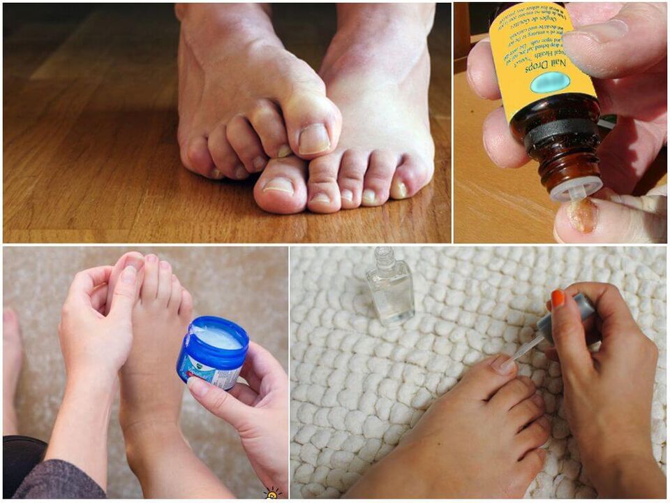 Treatment of nail fungus with antifungal solutions, ointments and varnishes