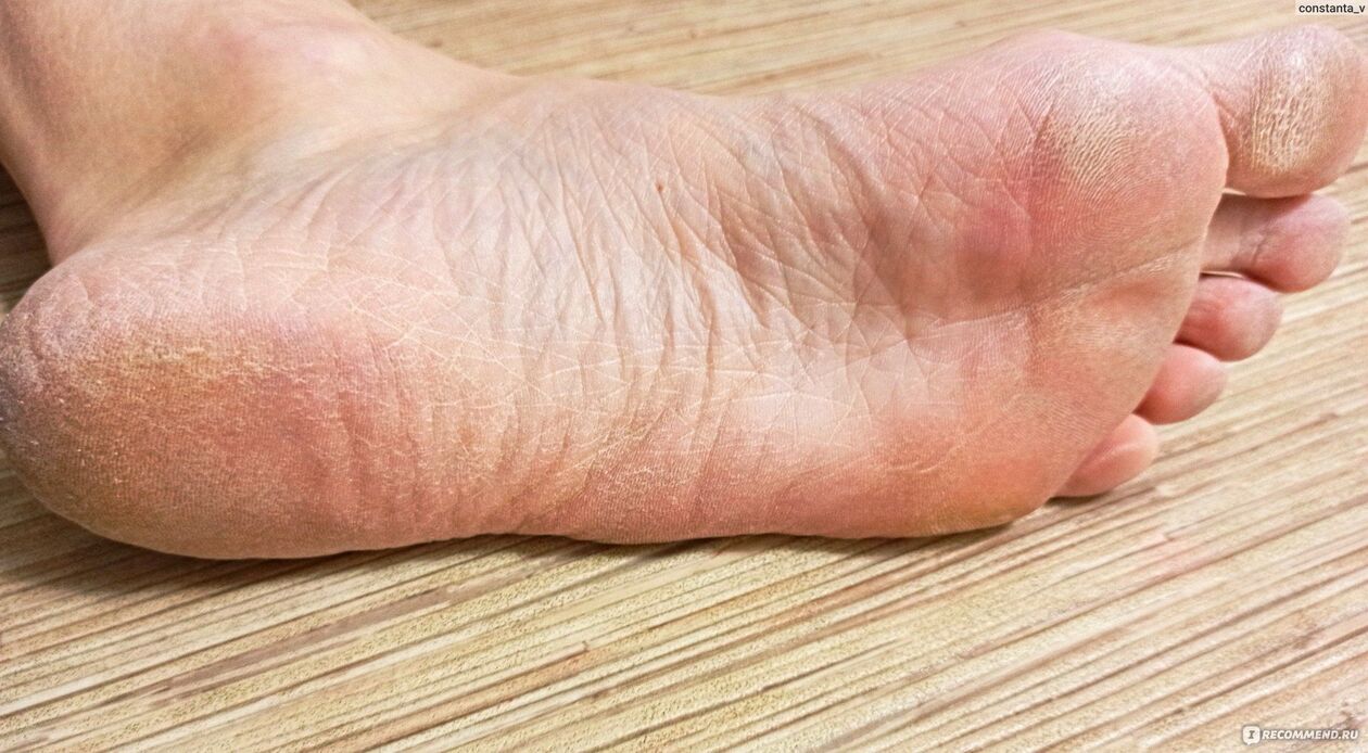 human foot fungus